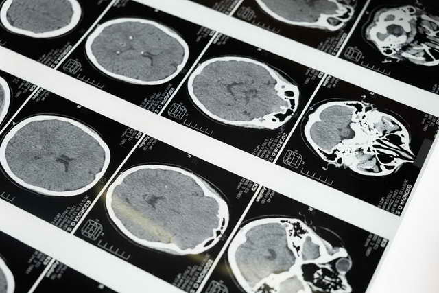 scan hemiplegic migraine